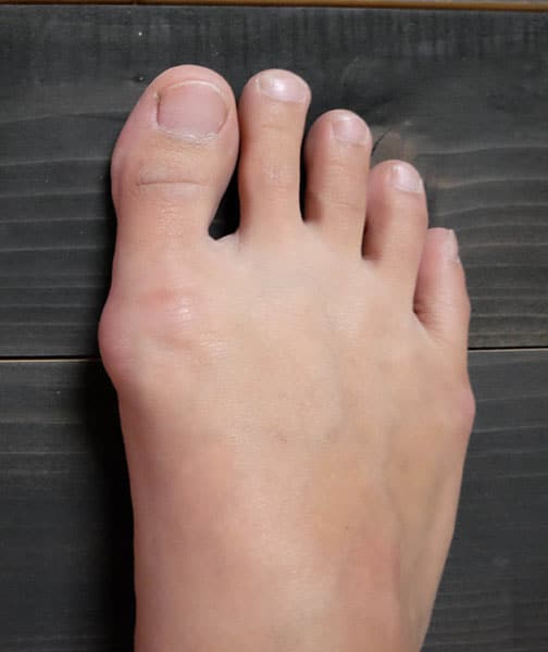 example of bunions