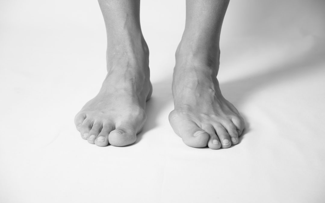 Do You Really Need Bunion Surgery? (Maybe Not!)
