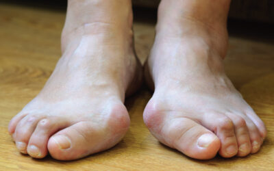 Available Treatments for Bunion Pain