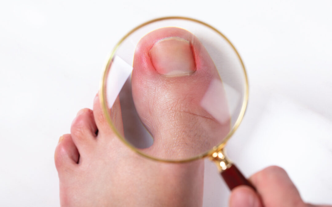 How to Prevent an Ingrown Toenail