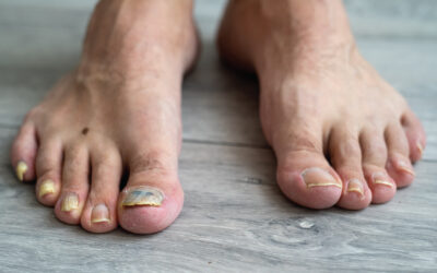 How to Get Rid of Toenail Fungus: A Guide to Treatment Options