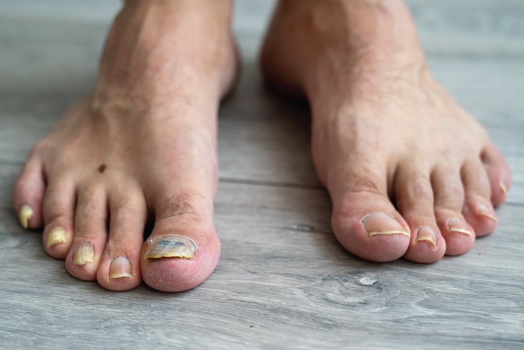How to Get Rid of Toenail Fungus Eugene Foot & Ankle