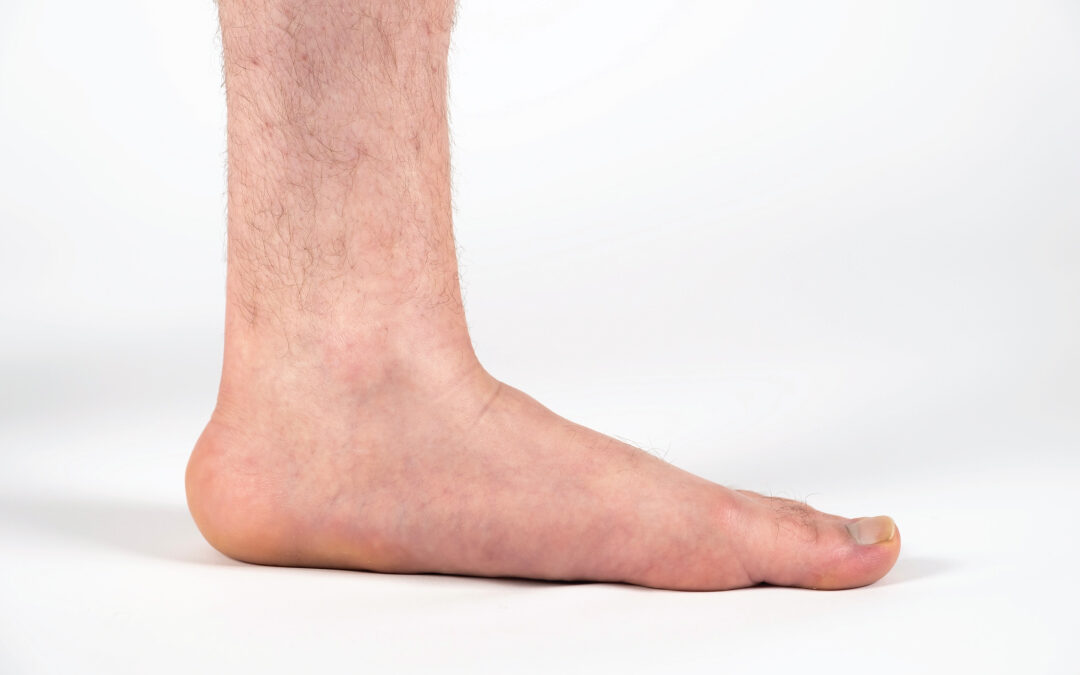 Understanding Your Feet: Collapsed Arch vs. Flat Feet