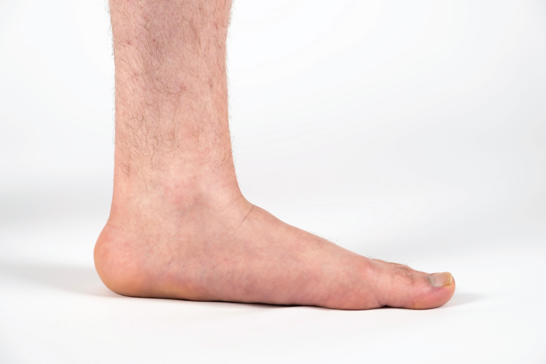 Collapsed Arch Vs Flat Feet Explained Eugene Foot And Ankle