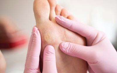 How to Prevent Calluses on Feet and Keep Them Healthy