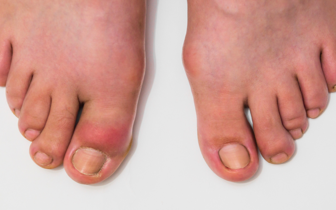 Bacterial Foot Infection Explained: Symptoms, Prevention, and Treatment