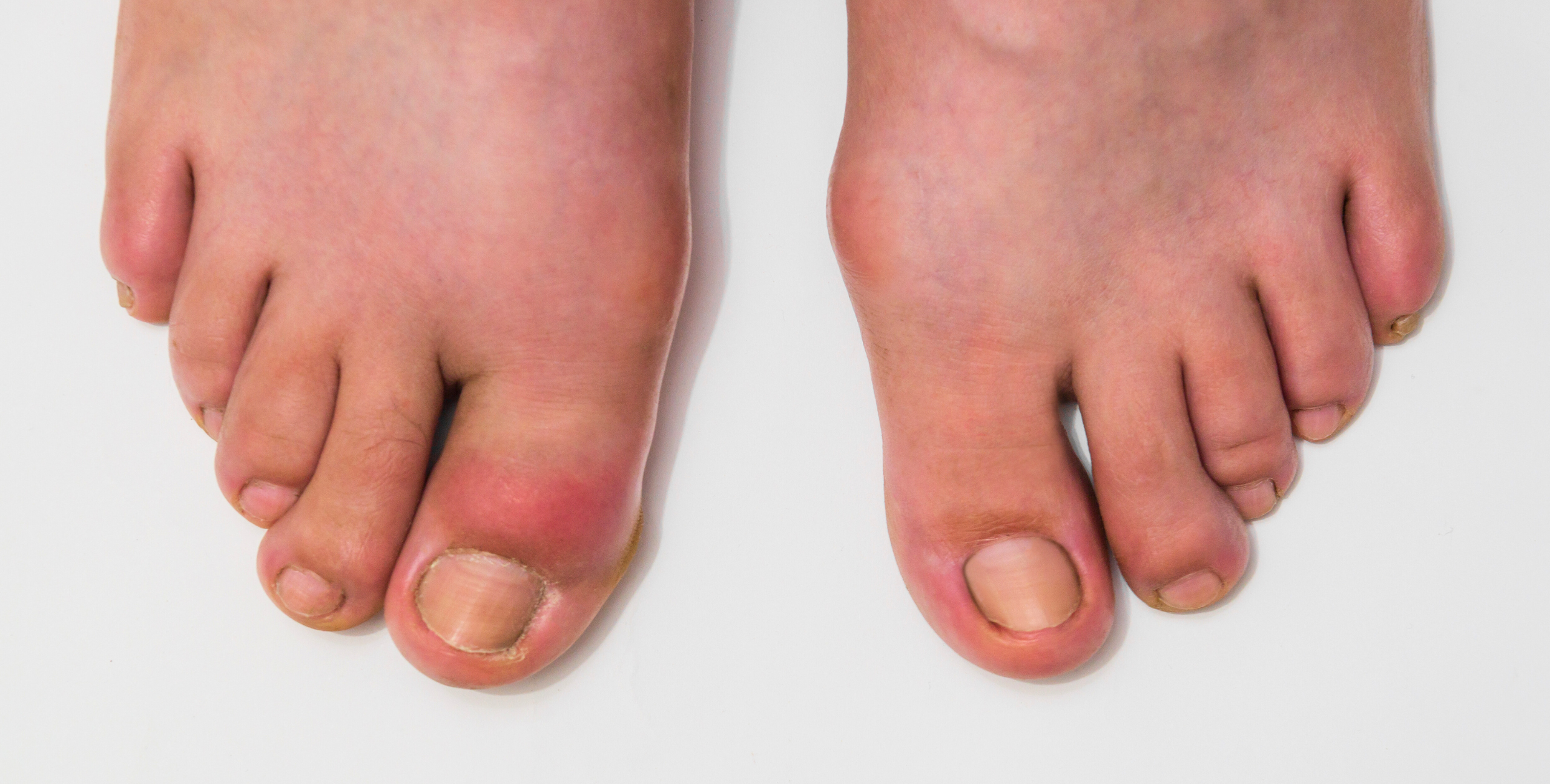 a set of feet where the big toe has a bacterial foot infection