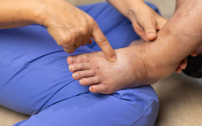Why Are My Feet Swollen? Common Causes of Foot Swelling