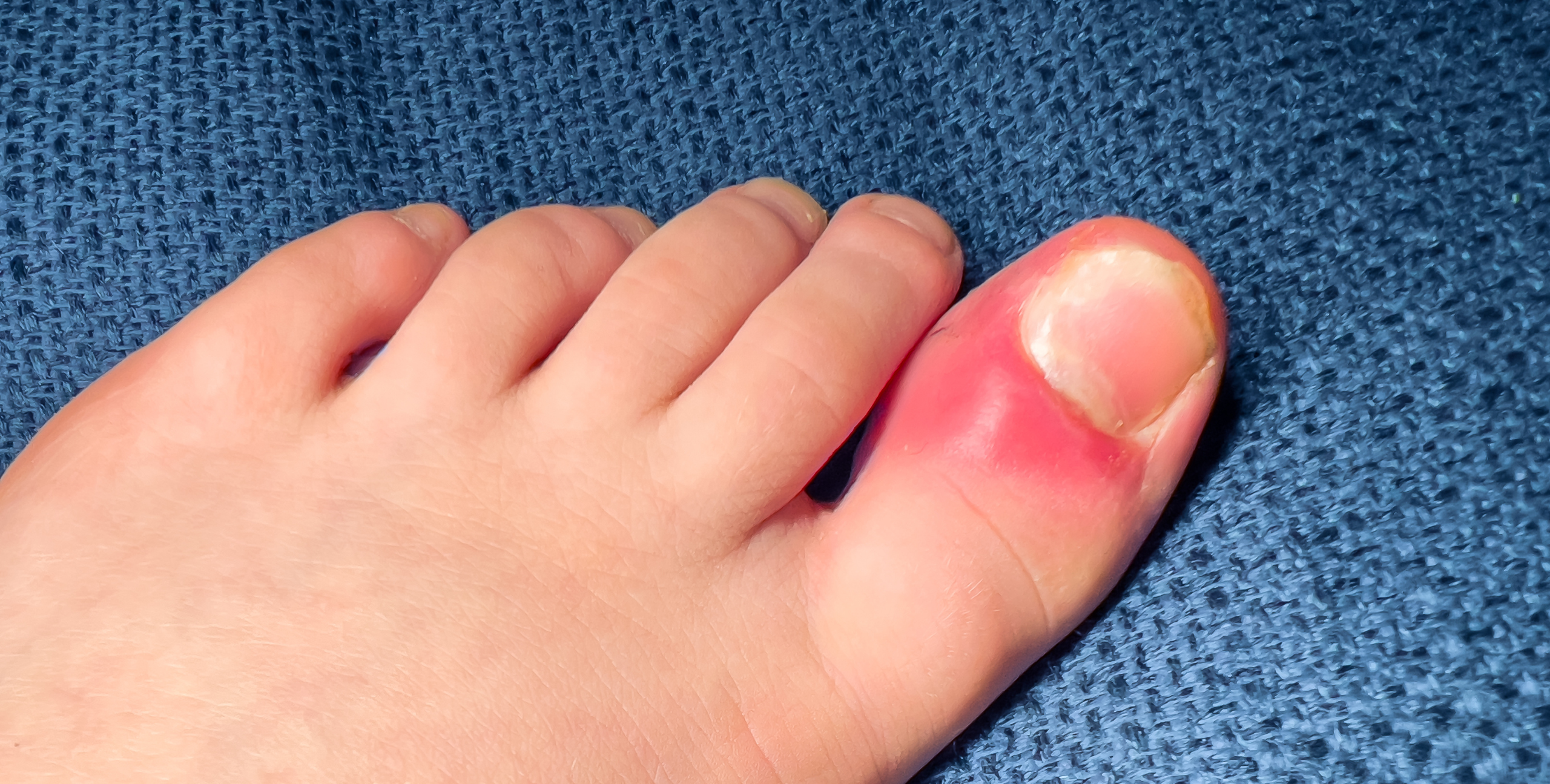 ingrown toenail as the cause of toe pain