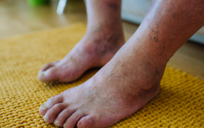 Diabetic Foot Care: How to Protect Your Feet
